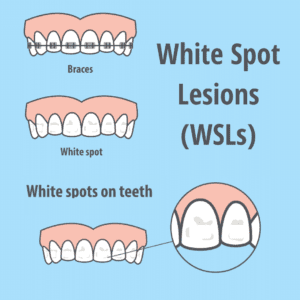 What are white spots on teeth and what can you do about them